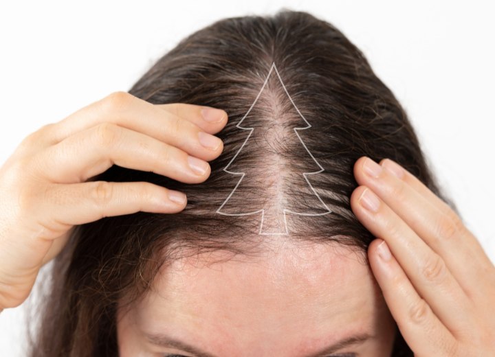 Queda de cabelo feminina no padr&atilde;o &aacute;rvore de Natal