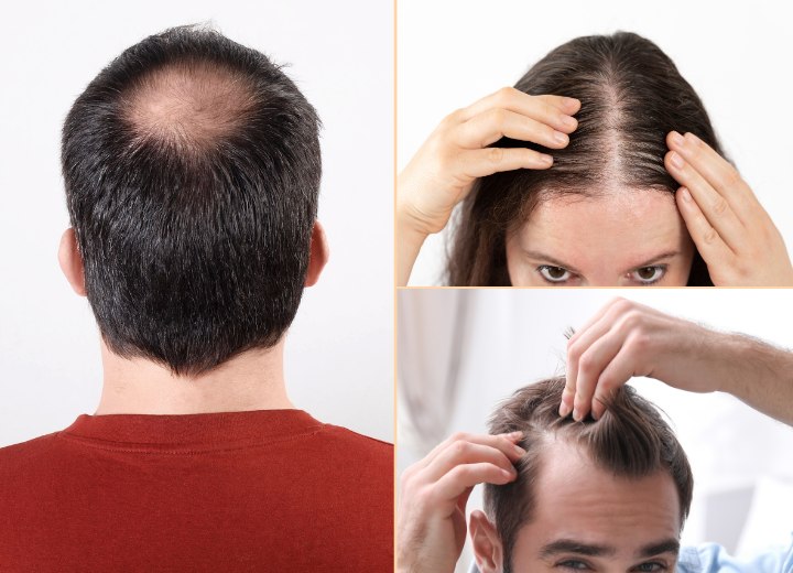 Queda de cabelo masculina e feminina